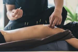 Séance d'acupuncture